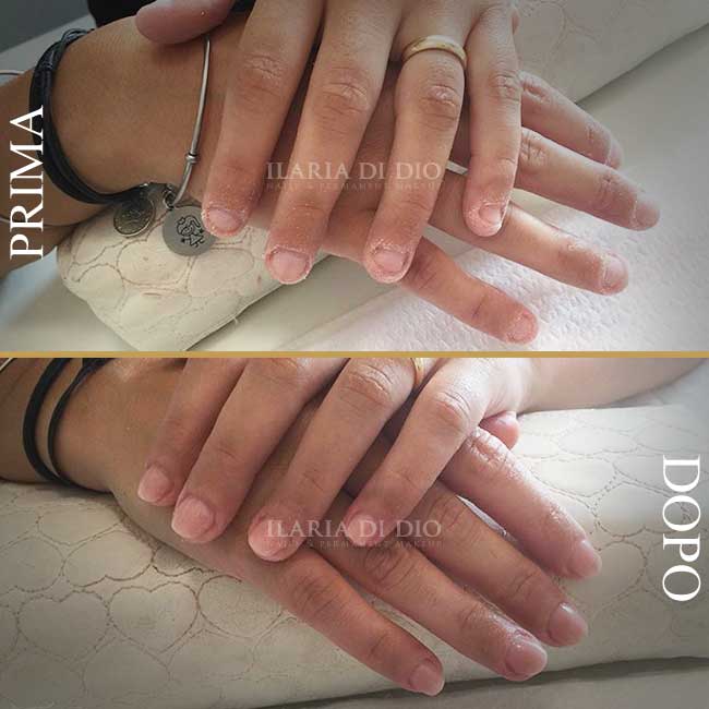 Ricostruzione unghie mangiate