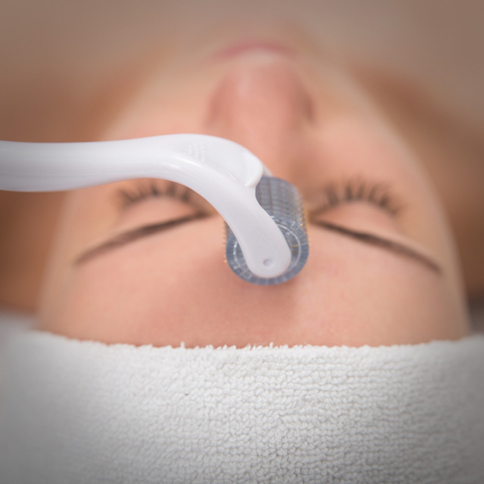Trattamento needling con dermaroller Roma